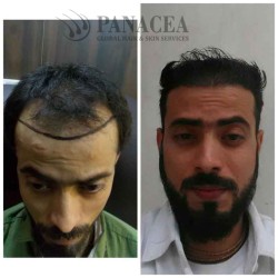 Which Hair Transplant Doctor In Delhi Should You Choose For Your Hair Transplant Surgery