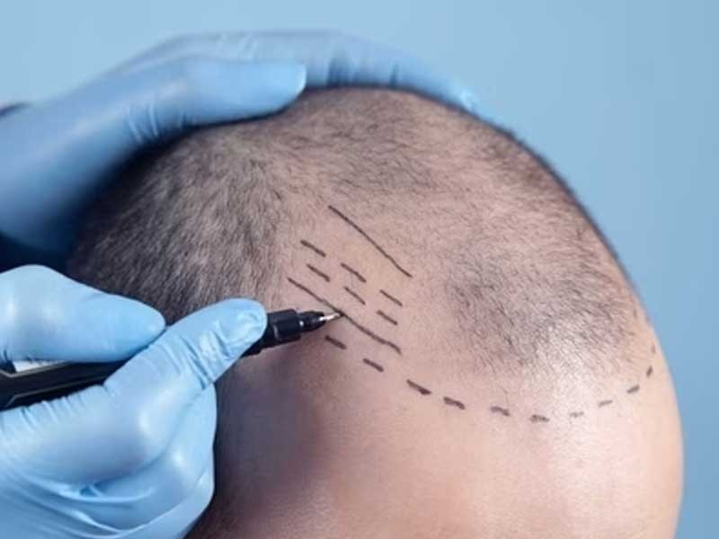 Which Hair Transplant Doctor In Delhi Should You Choose For Your Hair Transplant Surgery-pic_1